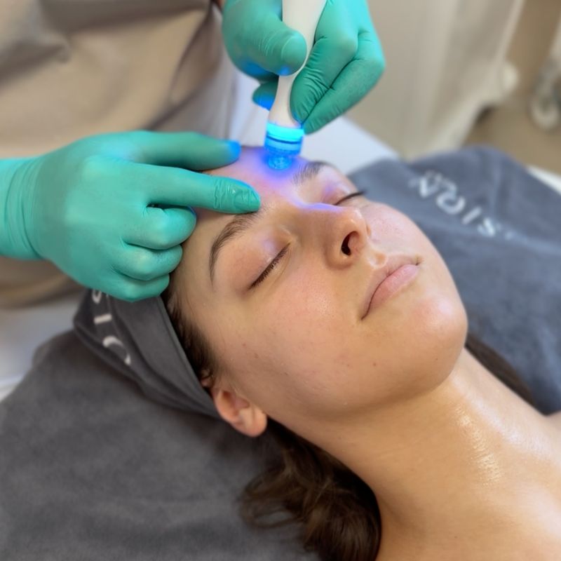 Aquapure Peeling
